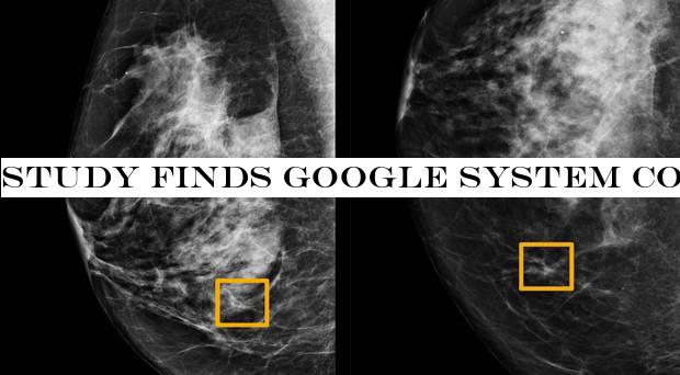 Study finds Google system could improve breast cancer detection