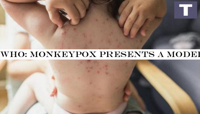 WHO: Monkeypox presents a moderate risk to public health